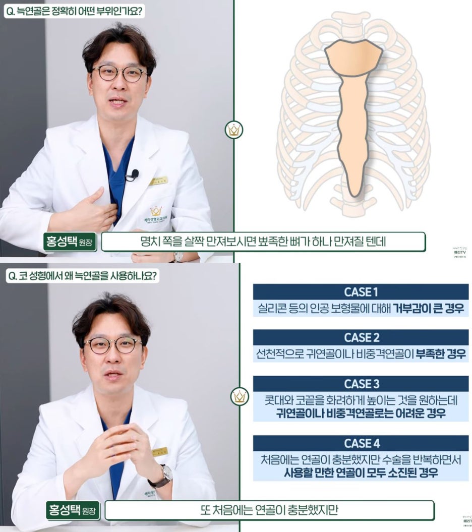 자가늑연골 코재수술 메리에서 마지막이 될 수 있도록 관련 이미지 3