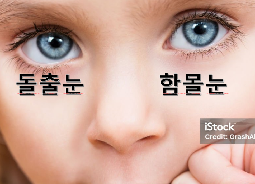 돌출눈 함몰눈 나는 어떤 눈일까? 관련 이미지 1