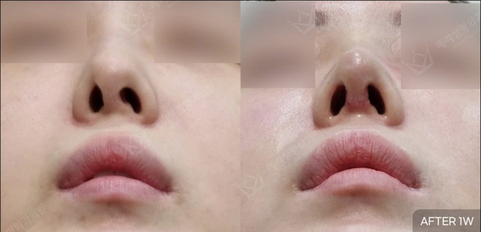 Post-Nose Surgery Pain Management :: How Pain Management Affects Recovery and Surgical Results, How Much It Hurts After Surgery, Painkillers After Surgery, Splint Removal, Merocel Removal image 4
