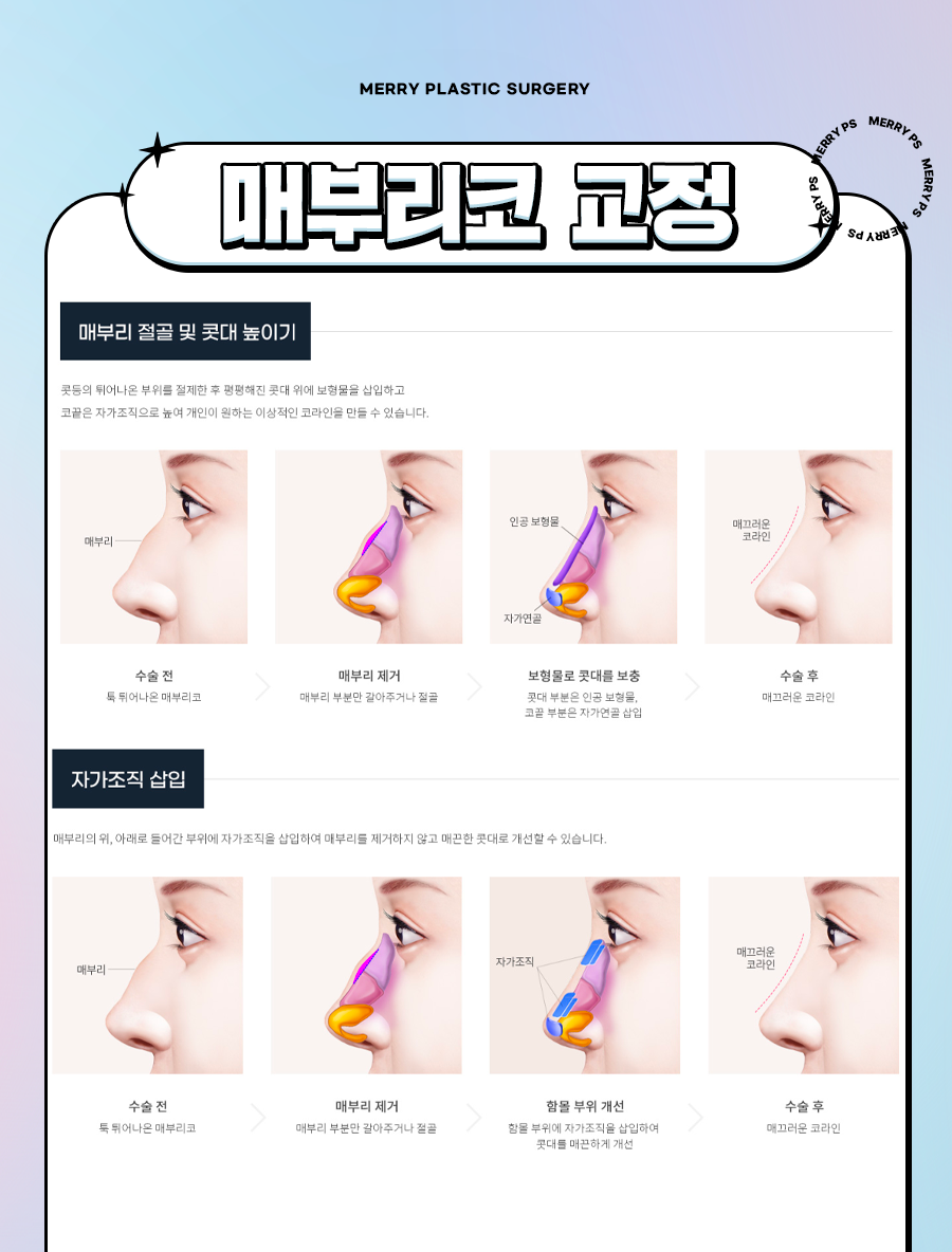 신사 매부리코 교정수술, 굴절 정도에 따라 맞춤형으로 관련 이미지 5