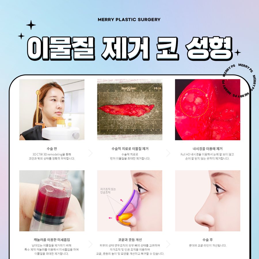 이물질 제거 코 성형 깔끔하게 이물질 제거하도록 관련 이미지 5