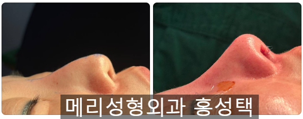 홍성택 원장의 수술노트 :: 구축코, 재생주사로 말랑하게 되돌린다음 코재수술하세요 관련 이미지 2