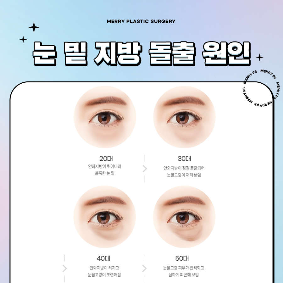 눈밑 다크서클 성형수술 유형에 따라 달라진다? 관련 이미지 3