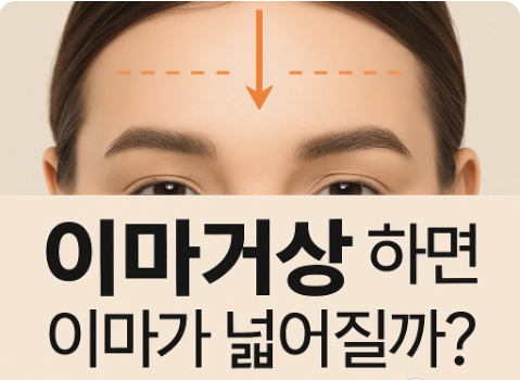 이마가 넓어질까 걱정된다면? 이마축소거상술로 해결하세요. 관련 이미지 5