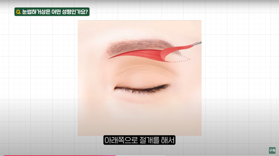 How Much Scarring Is Left After an Eyebrow Lift for Drooping Eyes? image 5