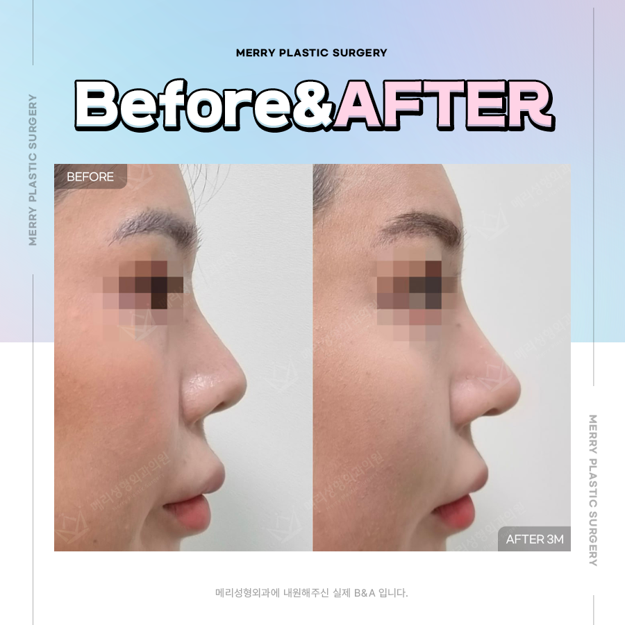 코끝재수술 연골 적절하게 채취하기 위해서는 관련 이미지 6