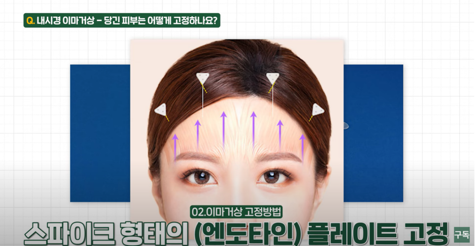 내시경 이마 거상수술을 하면 이마가 넓어질까? 관련 이미지 5