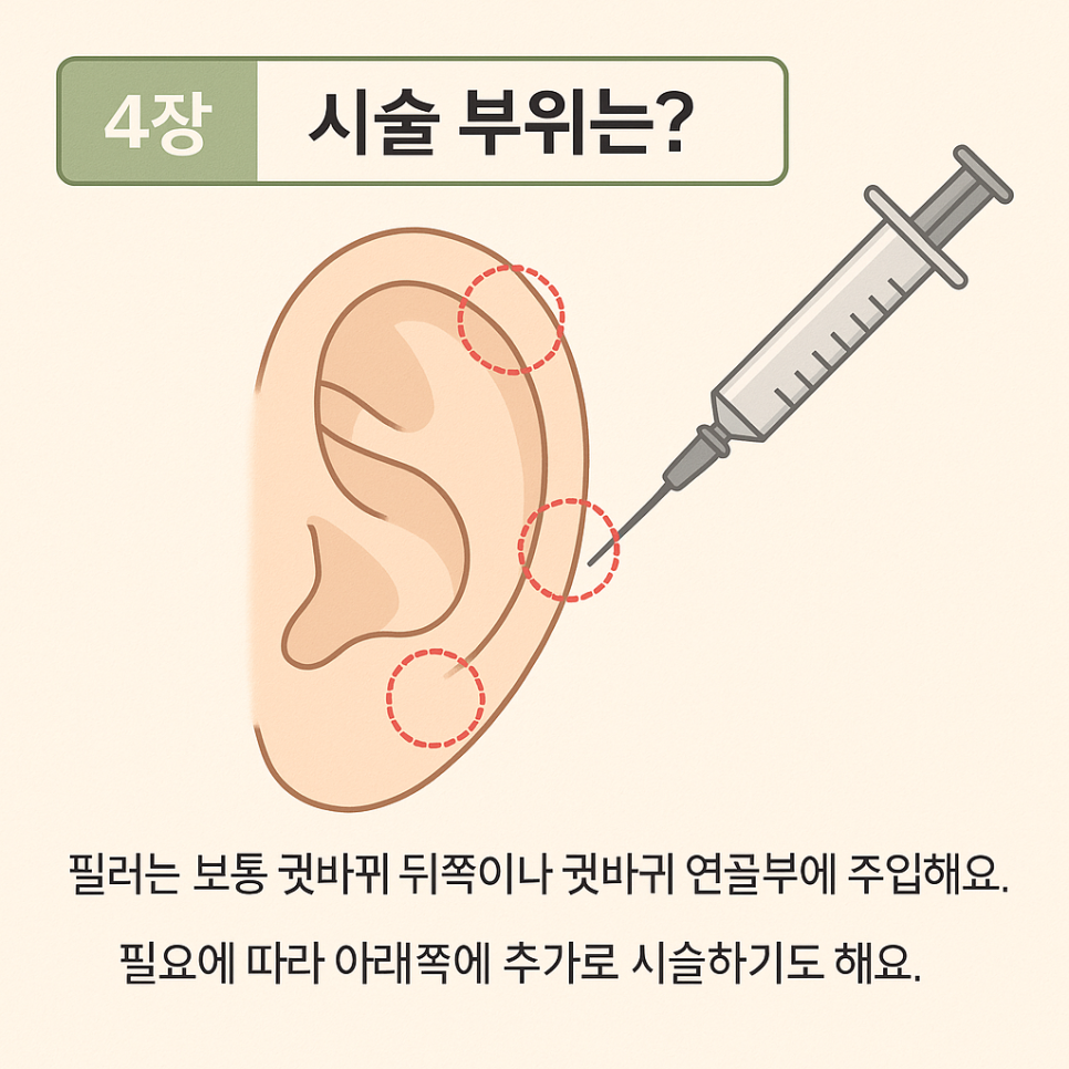 귀필러 :: 얼굴을 작아보이게 하는, 윤곽수술을 한듯한 착시효과, 귀필러 방법, 유지기간, 주의사항 관련 이미지 5