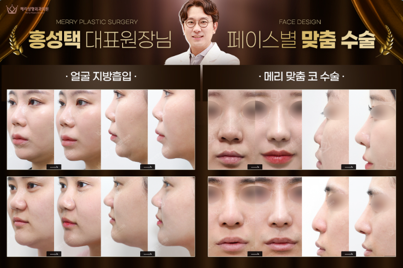 If Your Double Chin Still Looks Layered Even After Losing Weight? Mary Double Chin Zero Surgery, More Certain Than Prison Detox image 6