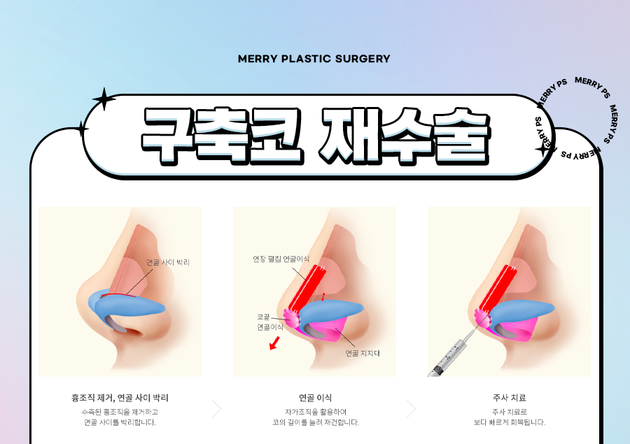 구축코 비주복구수술 자가 조직으로 탄탄하게 관련 이미지 4