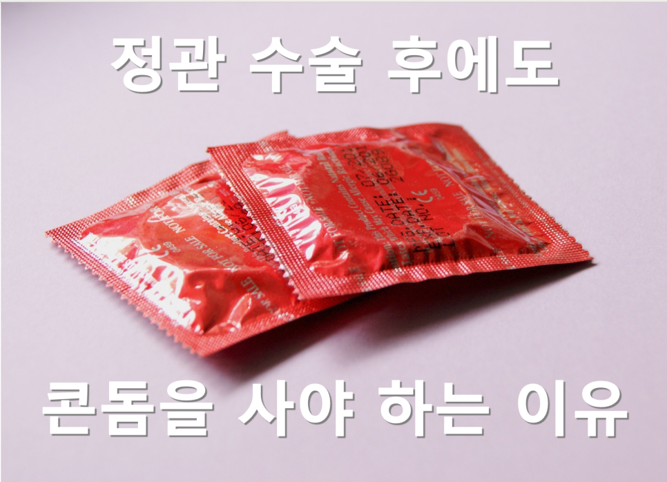 정관수술 후에는 콘돔을 사용하지 않아도 될까? 관련 이미지 1