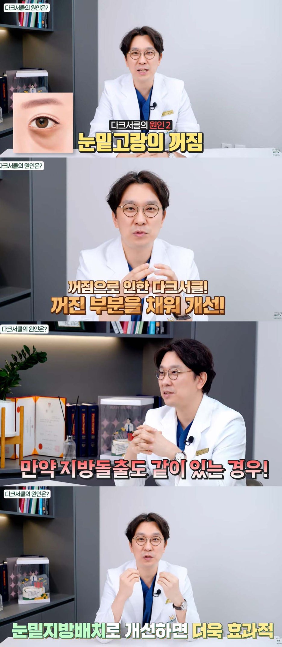 중년눈밑지방재배치수술 다크서클 개선할 수 있는 경우 관련 이미지 4