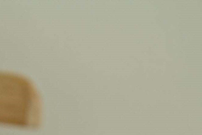Smooth Bulging Under-Eyes with Lower Blepharoplasty for Middle-Aged Eyes image 15