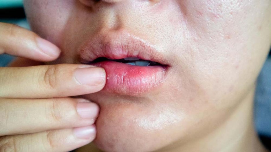 Herpes Lip Cold Sores Type 1 Treatment: Immunity Is the Key image 3