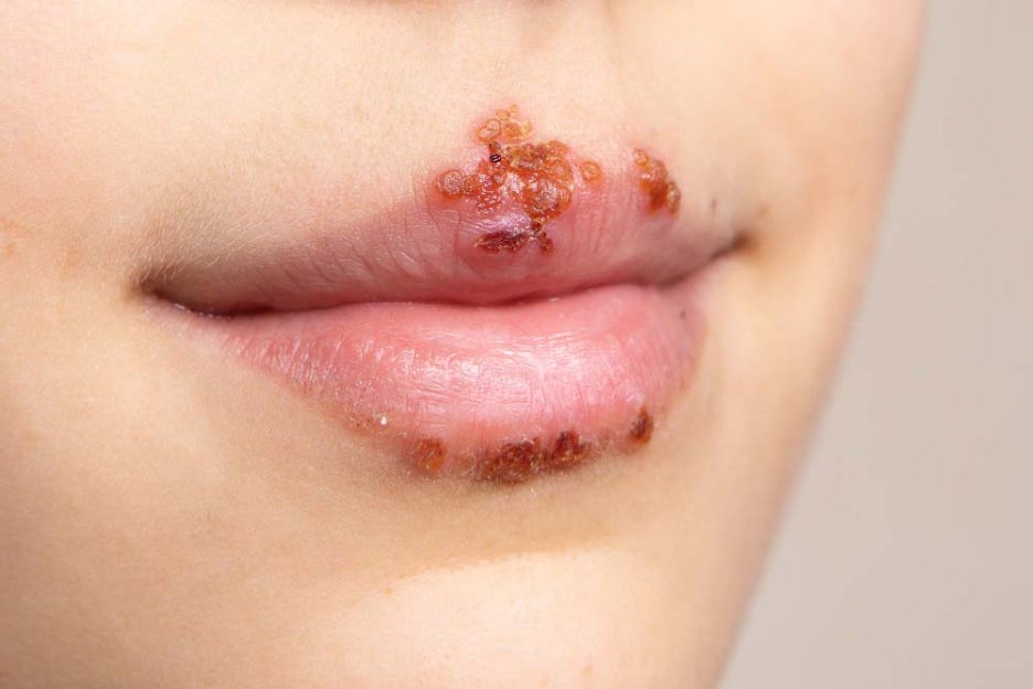 Herpes Lip Cold Sores Type 1 Treatment: Immunity Is the Key image 2