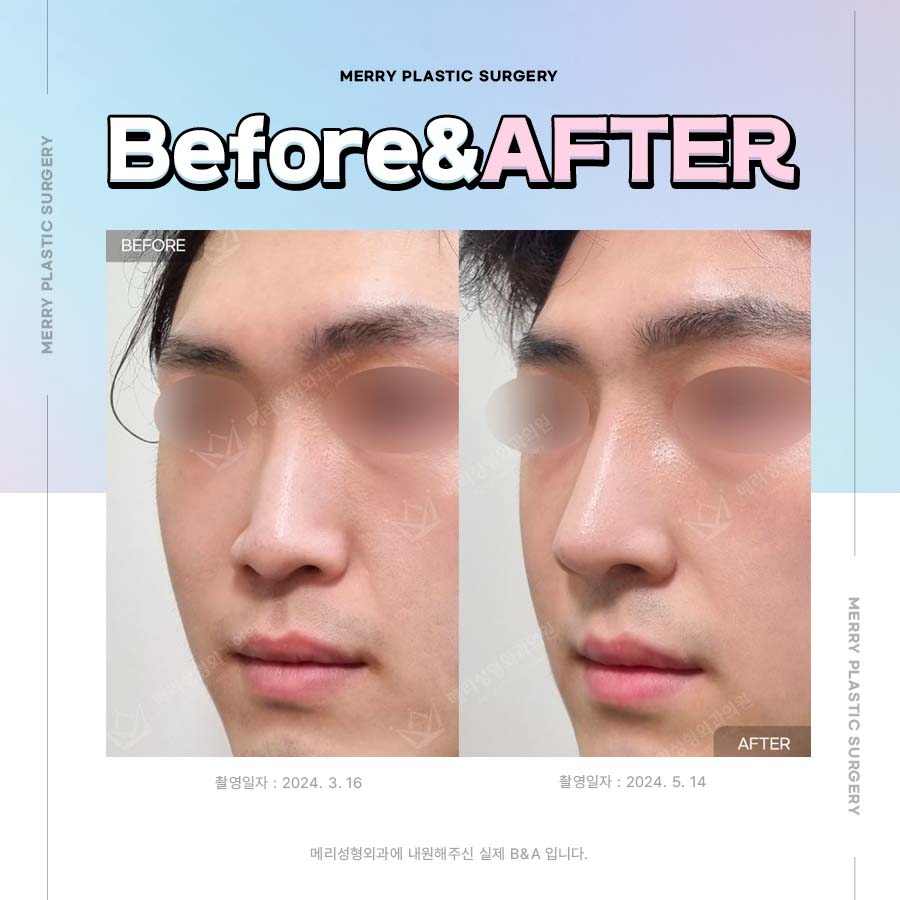 비중격만곡증 기능코로 자연스럽고 숨쉬기 편한코 관련 이미지 4