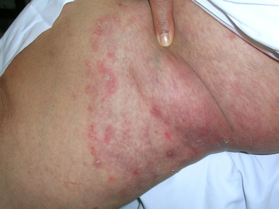 Summer Skin Conditions: How Can They Be Prevented and Treated? image 5