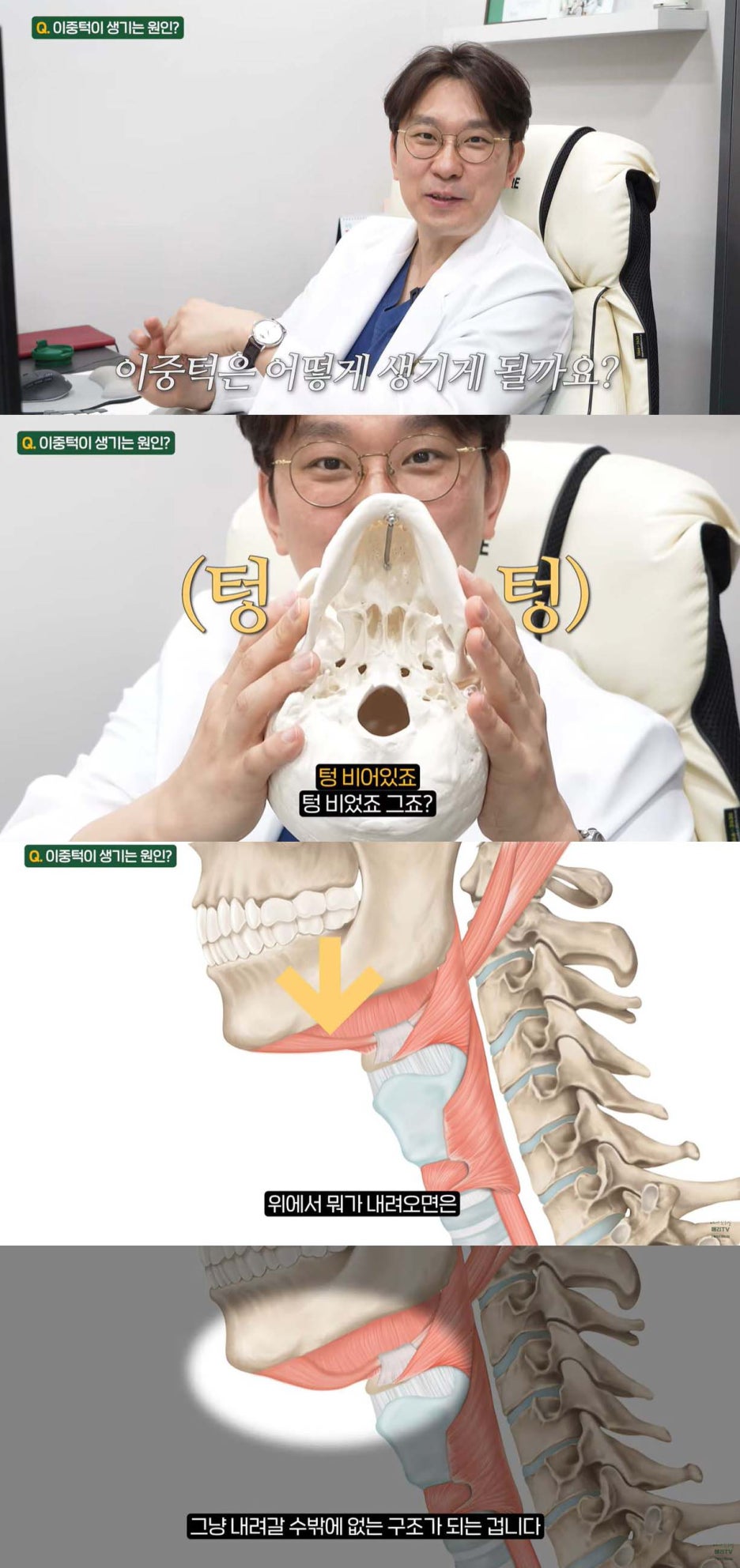 이중턱제로 얼굴지방흡입으로 쏙빼는 방법 관련 이미지 2