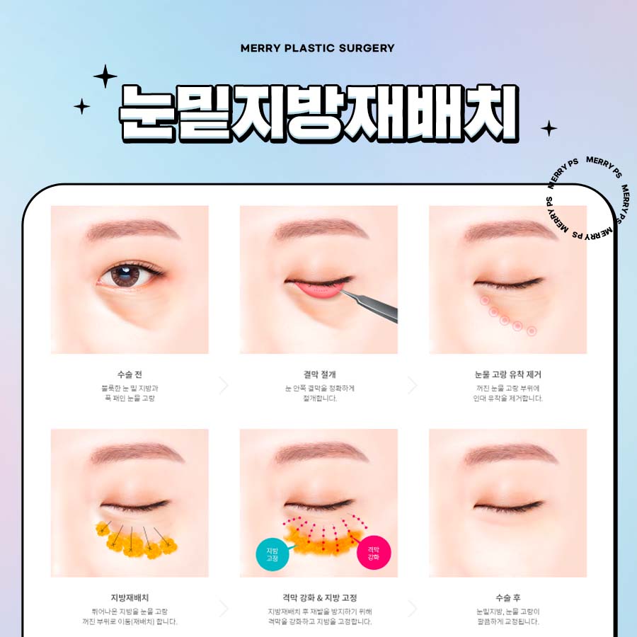 메리 눈밑지방재배치로 불룩한 눈밑을 생기있게 관련 이미지 5