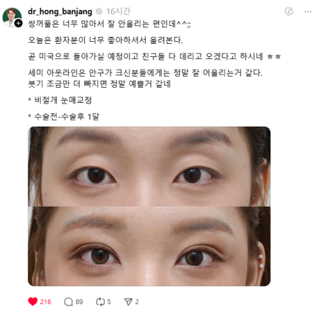 Surgery Story :: Semi Outline - What Face Shapes and Moods Does It Suit Best? A Story About Coming from the U.S. to See Mary and Being Told She Looked Like Lee Joo-bin image 2