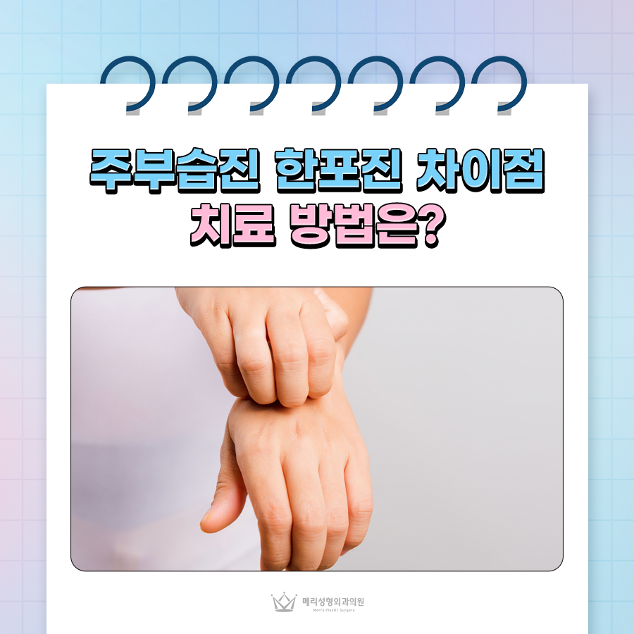 주부습진 한포진 차이점과 치료 방법은? 관련 이미지 1