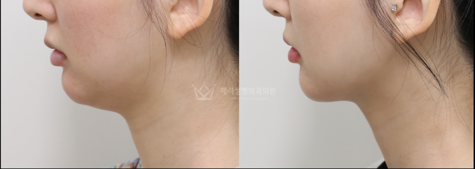 The 4 Ways to Say Goodbye to a Double Chin: What Are Their Effects and Order? image 4