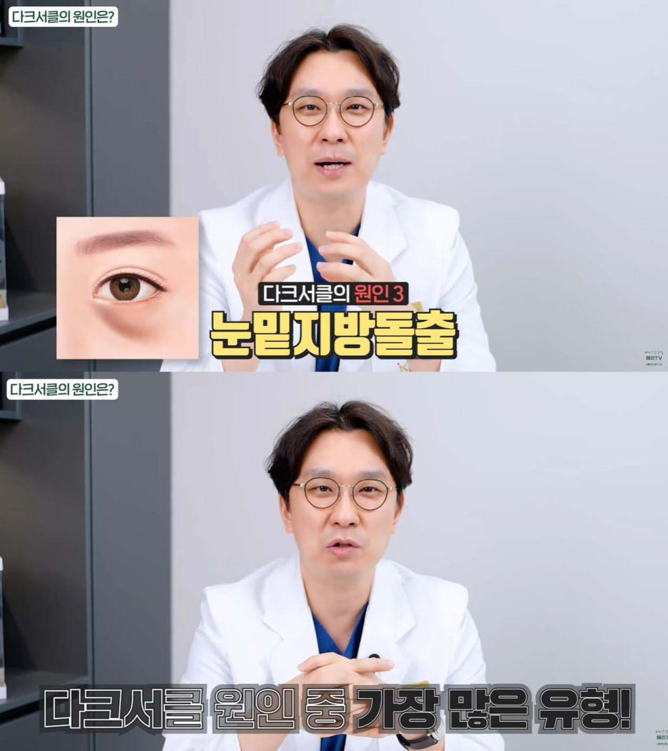 중년눈밑지방재배치수술 다크서클 개선할 수 있는 경우 관련 이미지 5