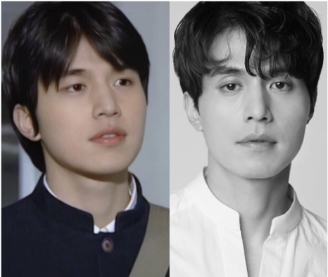Sunken Upper Eyelids, Eye Hollow :: Filling with Filler, Side Effects, Drooping Eyelids, Gubonseung’s Sunken Upper Eyelids, Lee Dong-wook’s Eye Hollow, Double and Triple Eyelids image 2