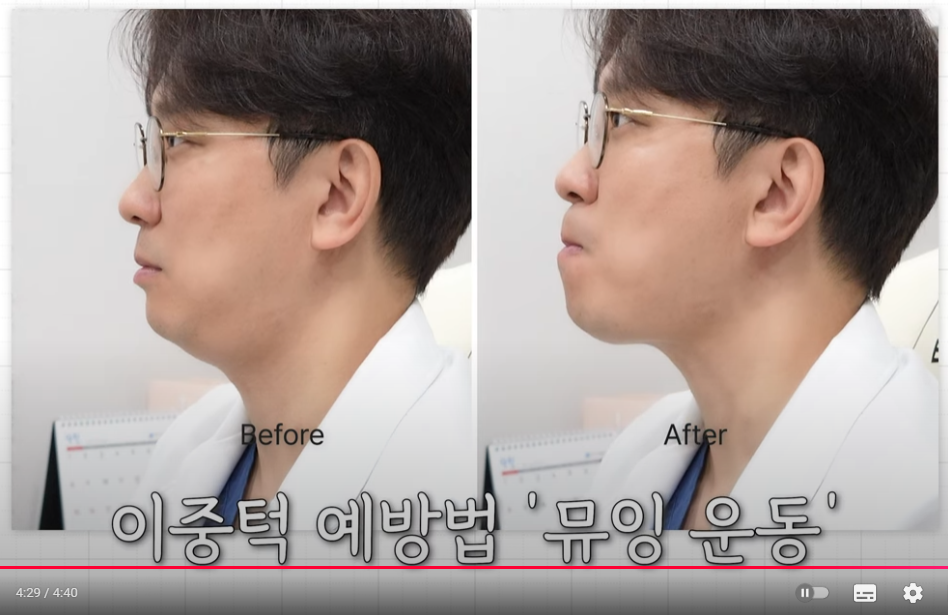 Tensioning Device :: Double Chin Muscle Tying, Facial Liposuction, Non-Surgical Post-Op Care image 10