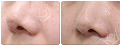 Contracted Nose :: If you’re concerned about thinned skin from a contracted nose, visible silicone, or a step-off at the nasal tip silicone — Mary Mallang Ju-sa image 3