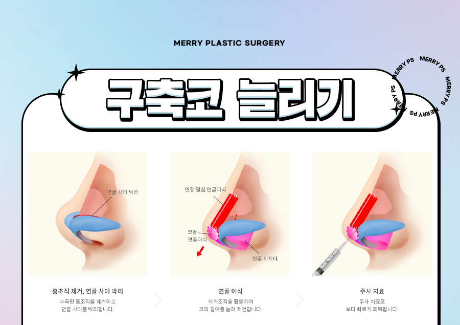 구축코 늘리기 변형된 코 재건 수술로 다시 한번 관련 이미지 4