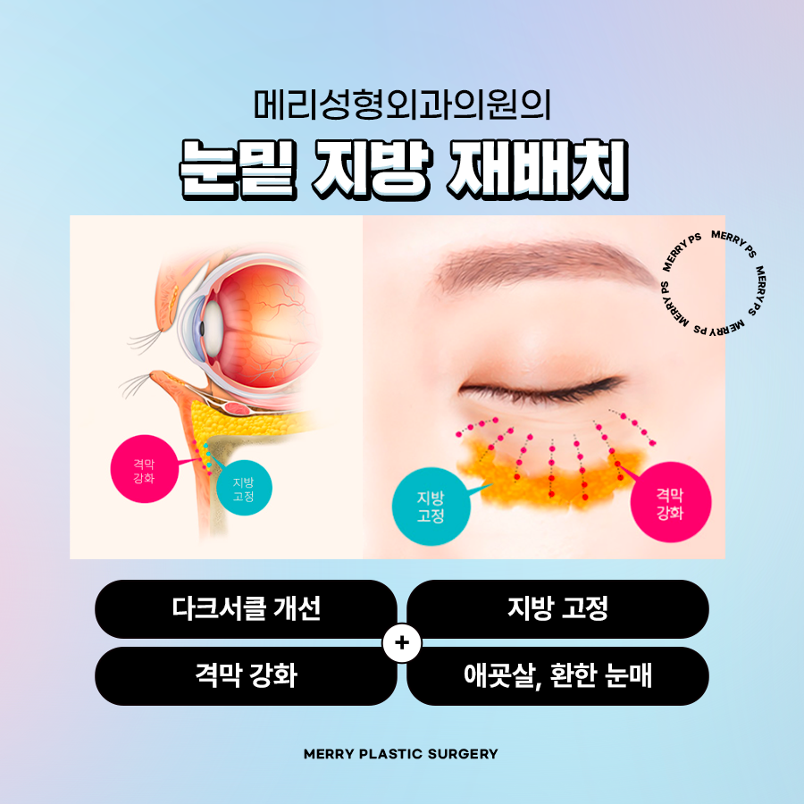 눈밑 다크서클 성형수술 유형에 따라 달라진다? 관련 이미지 4