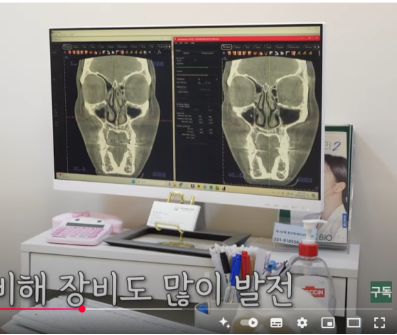 매부리코 수술 :: 압구정 성형외과에서 코재수술, 수술 후 관리, 수술 효과 관련 이미지 5