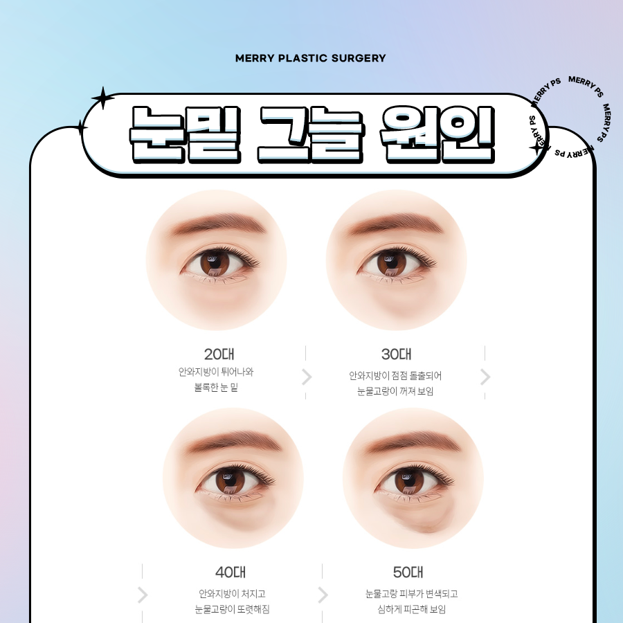 신사동 눈밑지방재배치 연령대별로 다른 원인과 증상에 따라 관련 이미지 3