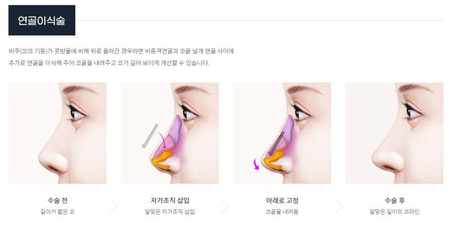 서울 코성형 짧은코 내 얼굴 비율에 맞게 관련 이미지 5