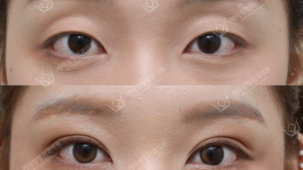 Surgery Story :: Semi Outline - What Face Shapes and Moods Does It Suit Best? A Story About Coming from the U.S. to See Mary and Being Told She Looked Like Lee Joo-bin image 6