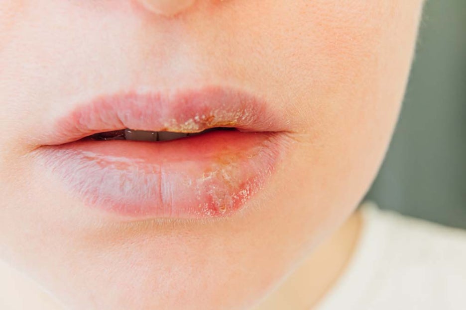 Herpes Lip Cold Sores Type 1 Treatment: Immunity Is the Key image 4