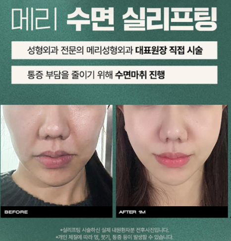 실리프팅 :: 중안면부 탄력/팔자주름 고민? 실리프팅으로 당기고, 유지하세요! 관련 이미지 3