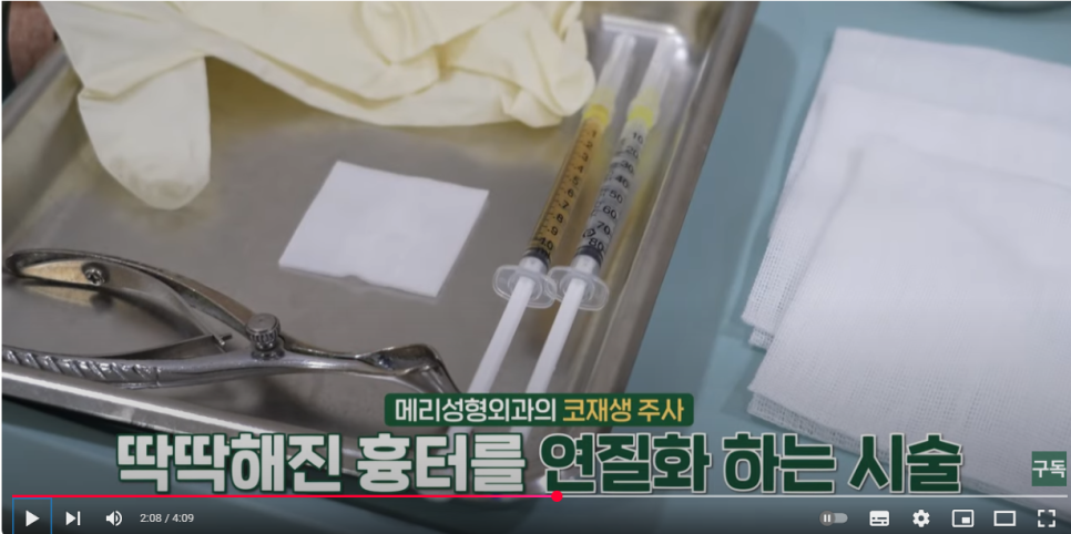 A regenerative injection that softens a contracted nose, the Malangi Injection :: For those who want revision rhinoplasty as soon as possible and for those who want to improve revision results image 5