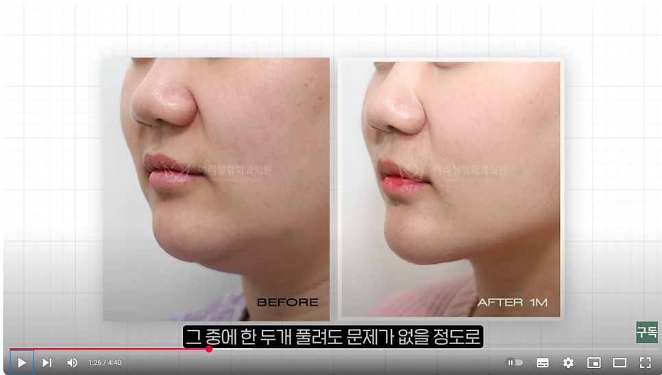 Tensioning Device :: Double Chin Muscle Tying, Facial Liposuction, Non-Surgical Post-Op Care image 4
