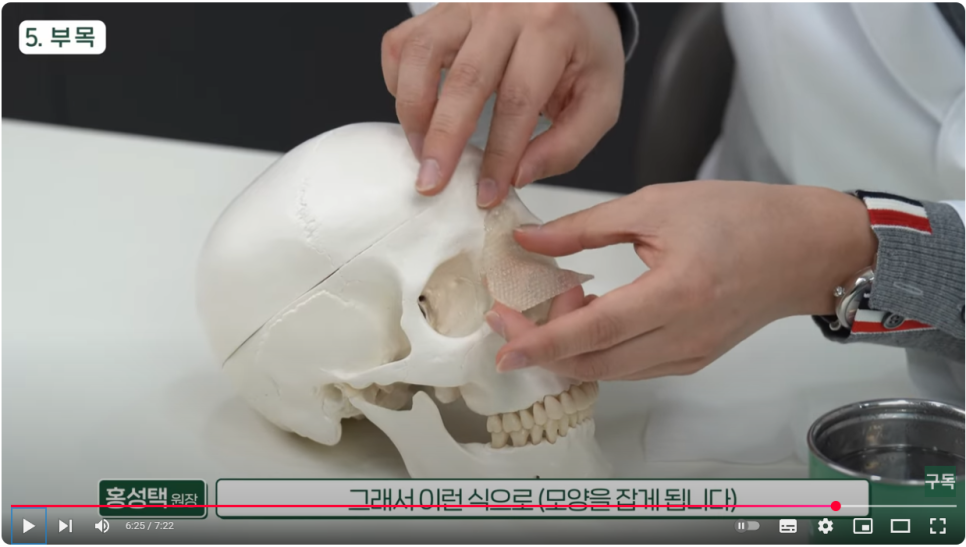 Post-Rhinoplasty Care :: When to Remove the Splint and Tape, Wound Care, and Nasal Congestion image 6