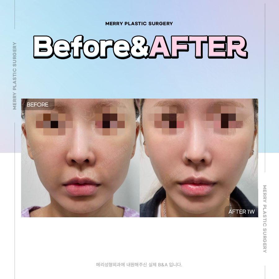 실루엣소프트 장점 다른 실 종류와 차이 고려하여 관련 이미지 5