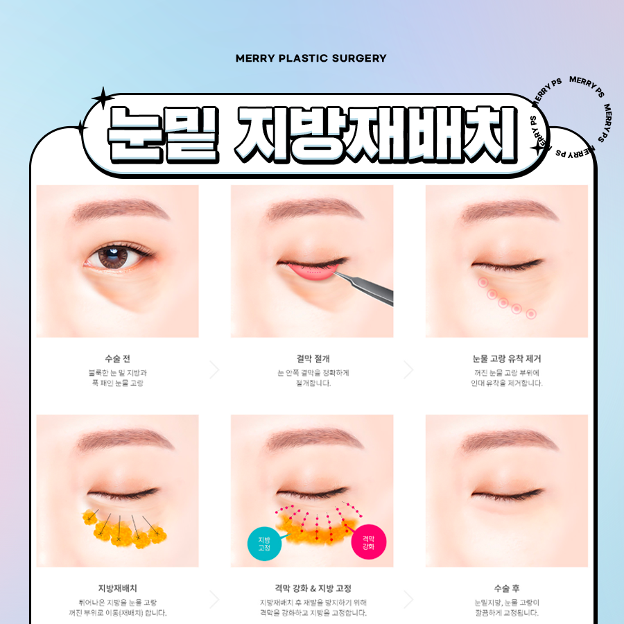 Under-Eye Bag and Dark Circle Surgery So You Won’t Be Mistaken for Looking Tired image 5