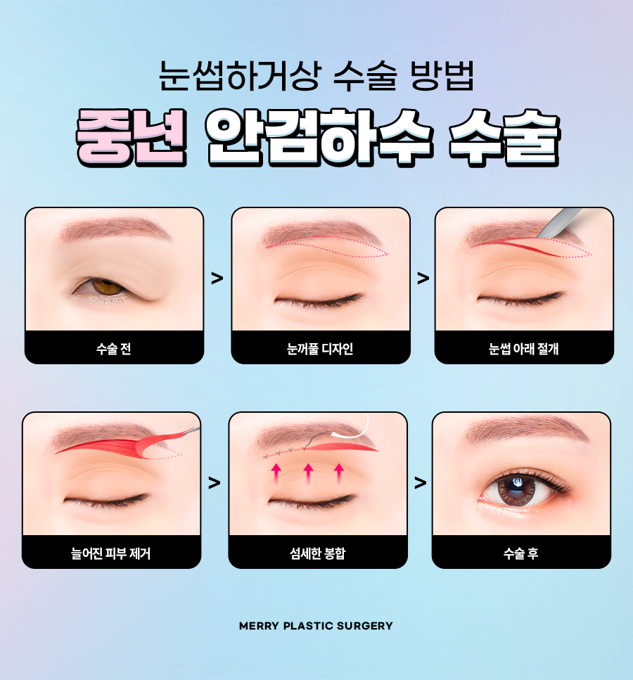 중년 안검하수 수술 처짐 정도에 따라 달라지는 방법은? 관련 이미지 5