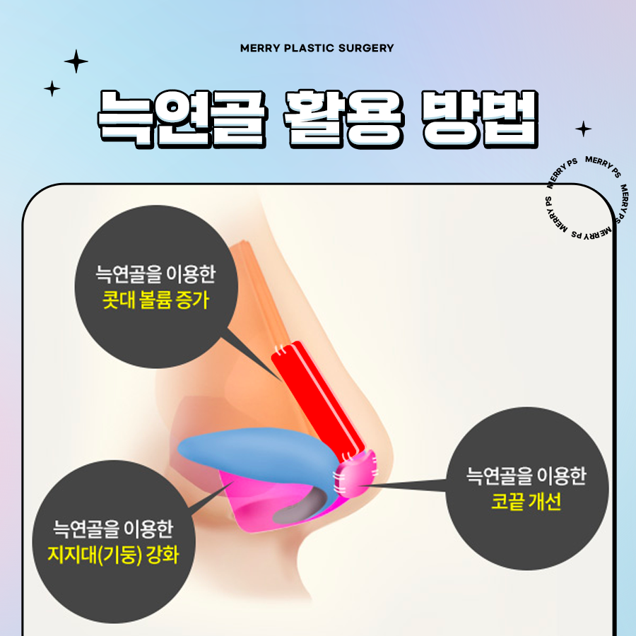 코끝재수술 연골 적절하게 채취하기 위해서는 관련 이미지 4