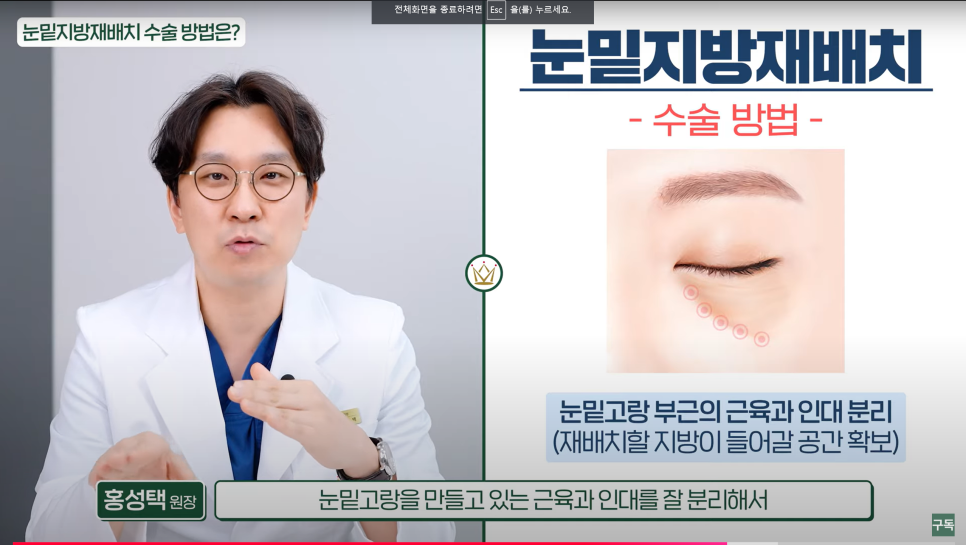 Tired of Hearing That Dark Circles Make You Look Older? Solve It with Just One Surgery image 2