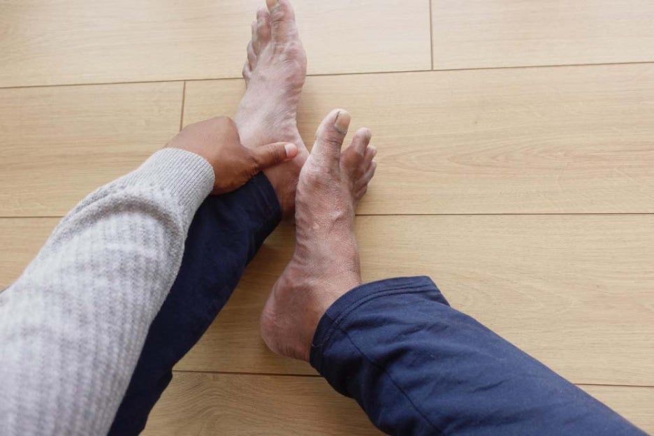 What Causes Big Toe Swelling and Pain? Are These Early Symptoms of Gout? image 2