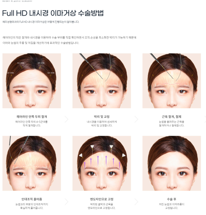 메리이마거상 :: 내시경을 이용한 이마거상술, 차이점과 흉터, 수술 내용까지 정리해봐요. 관련 이미지 3