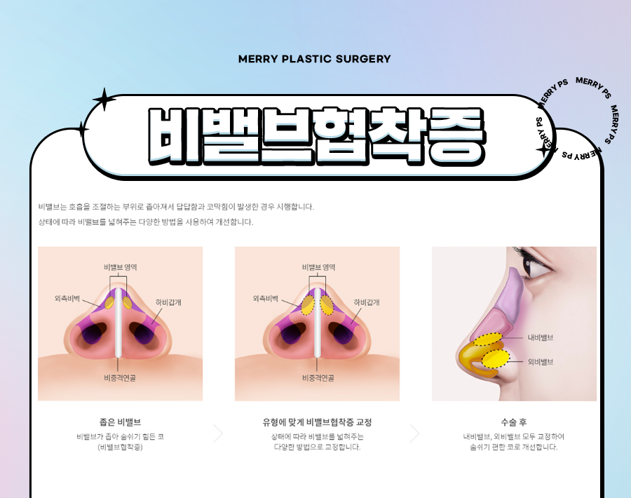 메리성형외과 기능코수술 숨쉬기 편안한 코 라인으로 관련 이미지 5