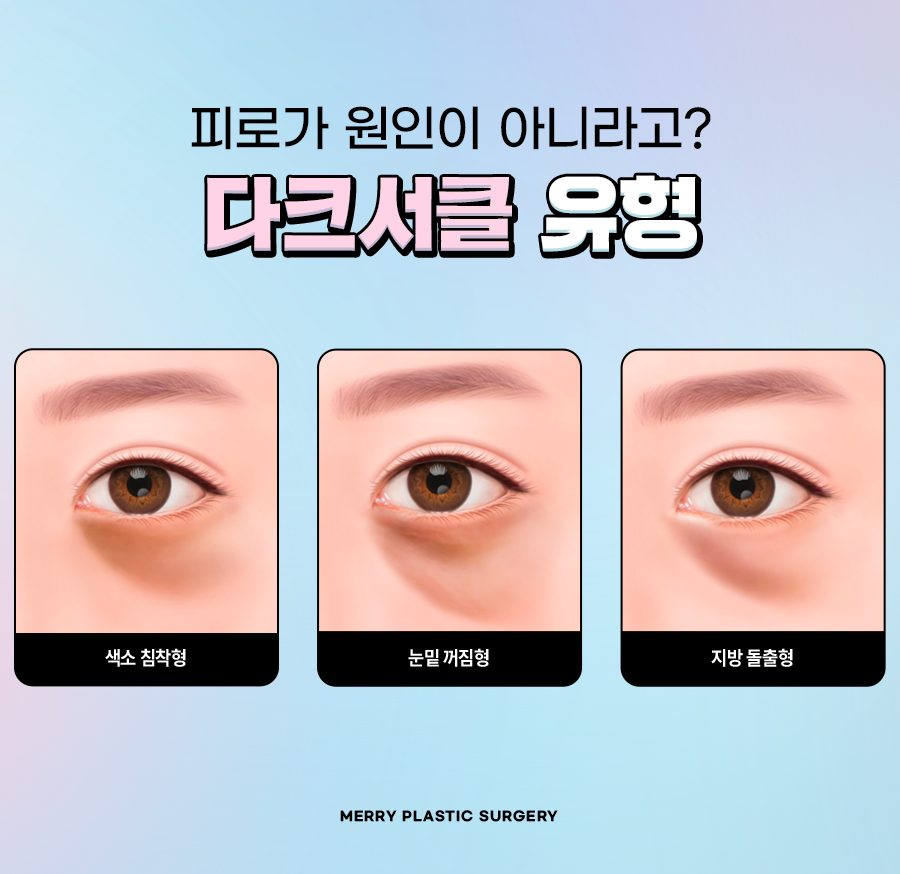 눈밑 다크서클 성형수술 유형에 따라 달라진다? 관련 이미지 2